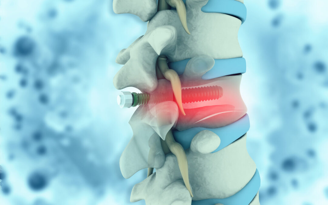 A Spine Surgeon with X-Ray Vision