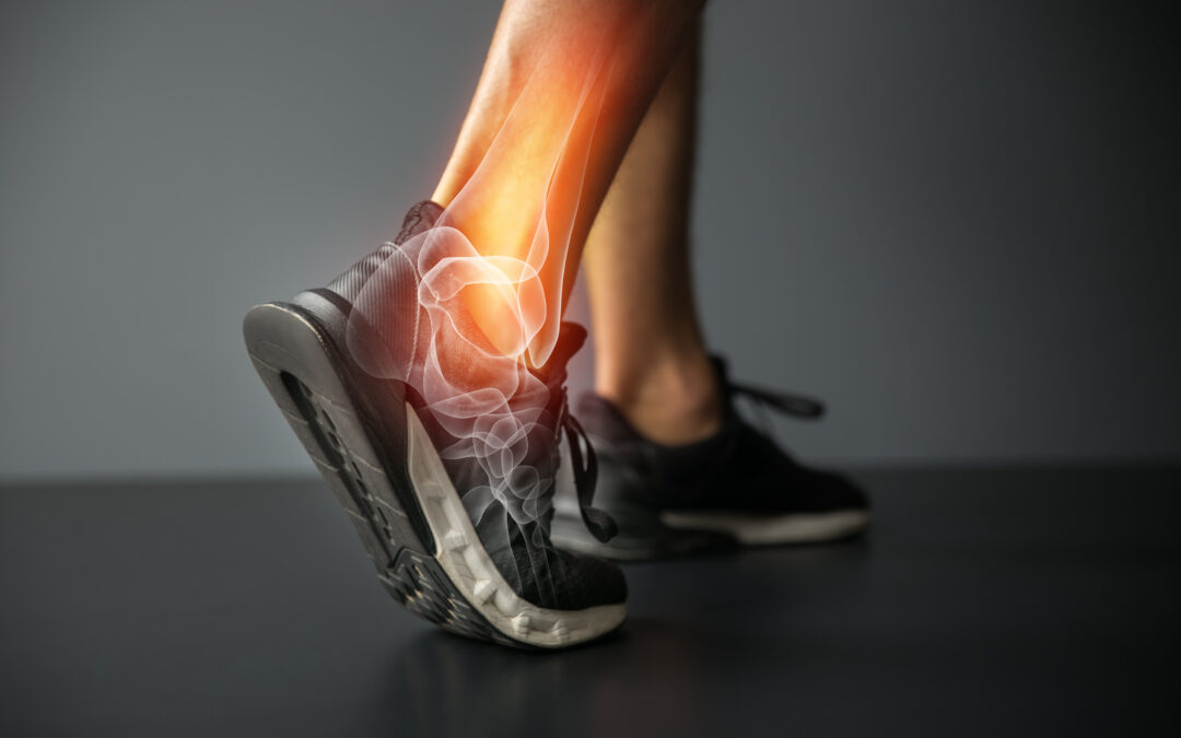 Relieving Painful Arthritis with an Ankle Replacement